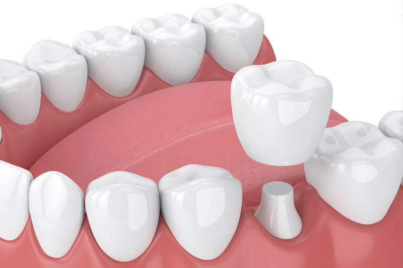 Dental Crowns in Burleson