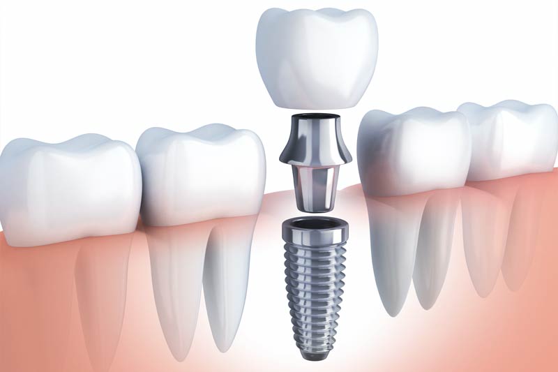 Implants Dentist in Burleson
