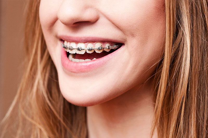 Orthodontics in Burleson