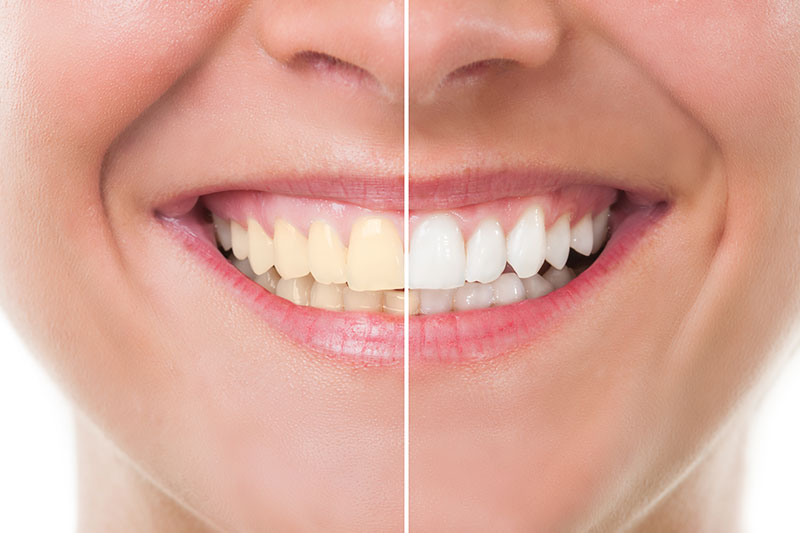 Teeth Whitening in Burleson