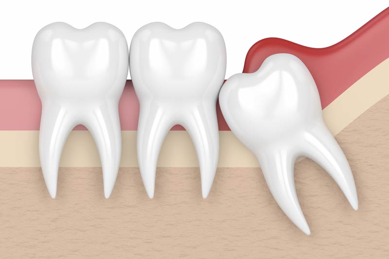 Wisdom Tooth Removal in Burleson